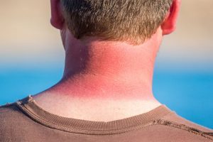 Sunburn