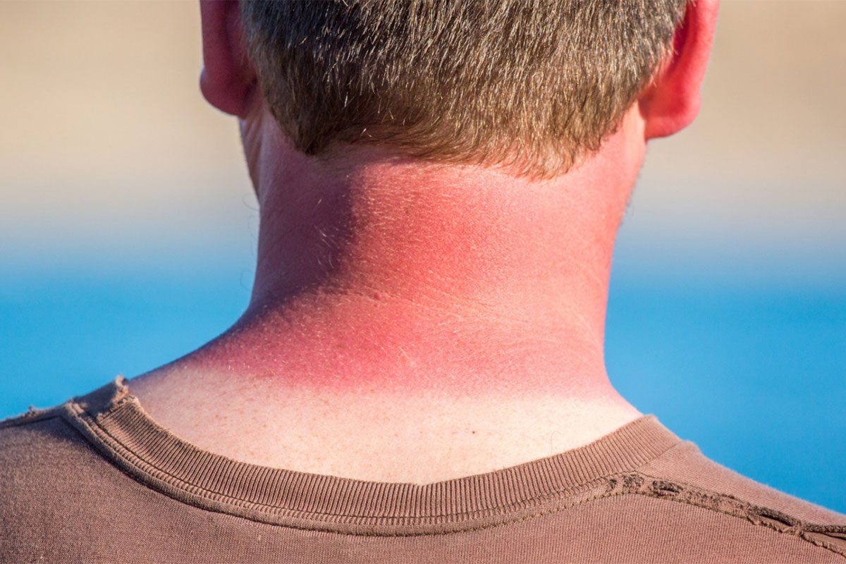 Sunburn